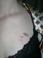lovebite